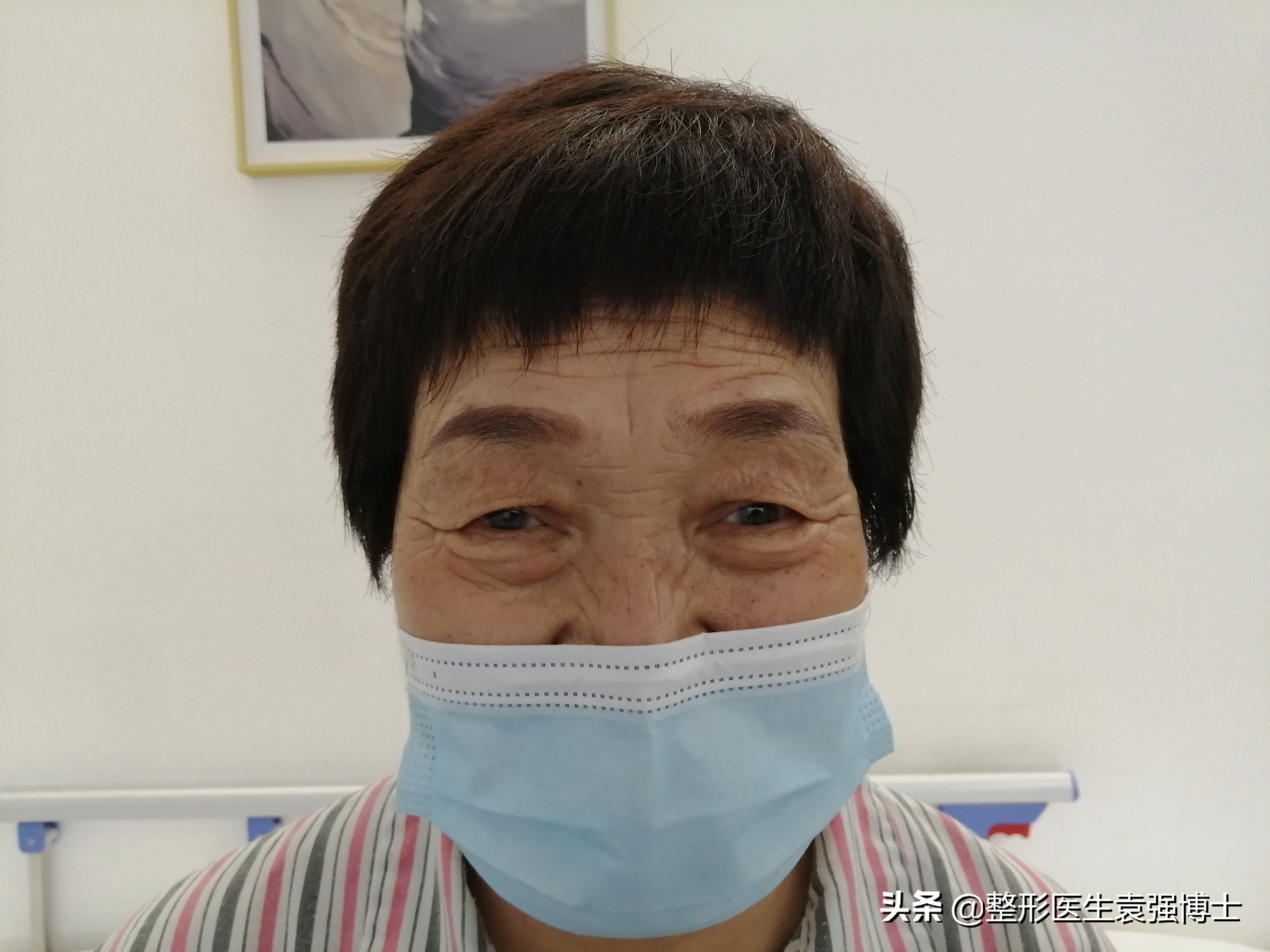 双眼皮提眉一起做半年效果,双眼皮提眉一起做几天能热敷