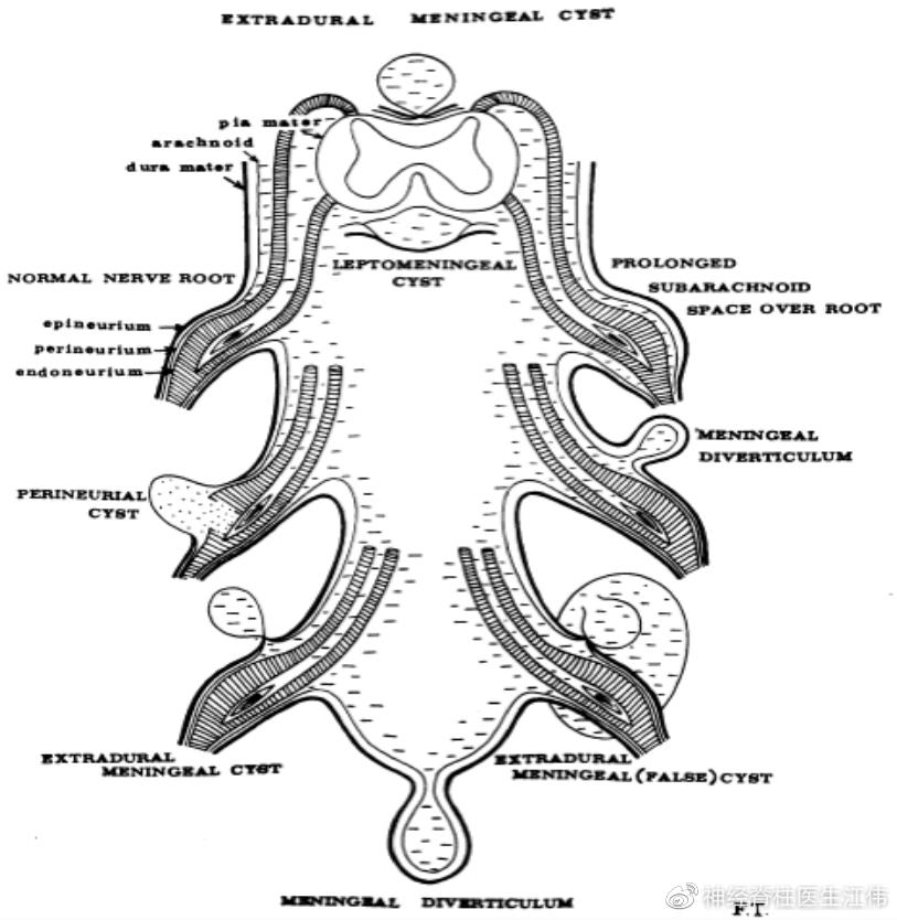 骶管囊肿介入治疗最新进展,骶管囊肿可以鉴定出来吗