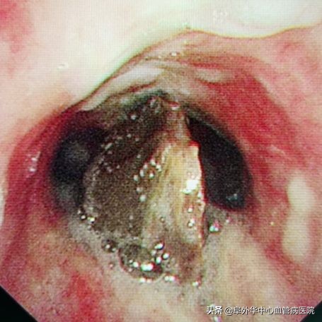 八旬老人误吞枣核肠,老人误吞枣核怎么化解