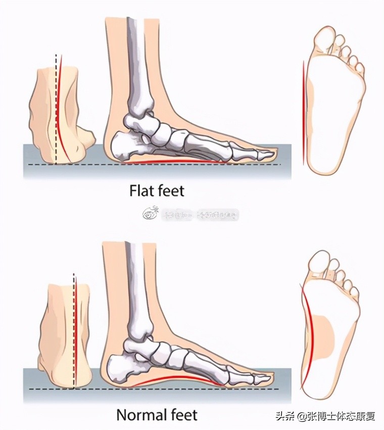 体态畸形怎么矫正,体态矫正腿型修复前景怎样