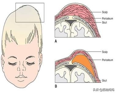 辟谣：“产瘤”十一天还没有消失，变硬就来不及了？要去抽出来？