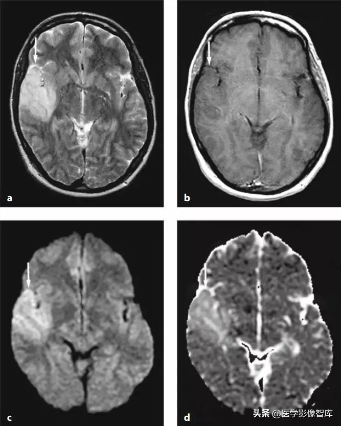 双侧额叶皮层区dwi偏高是什么意思,颅内dwi高信号病变