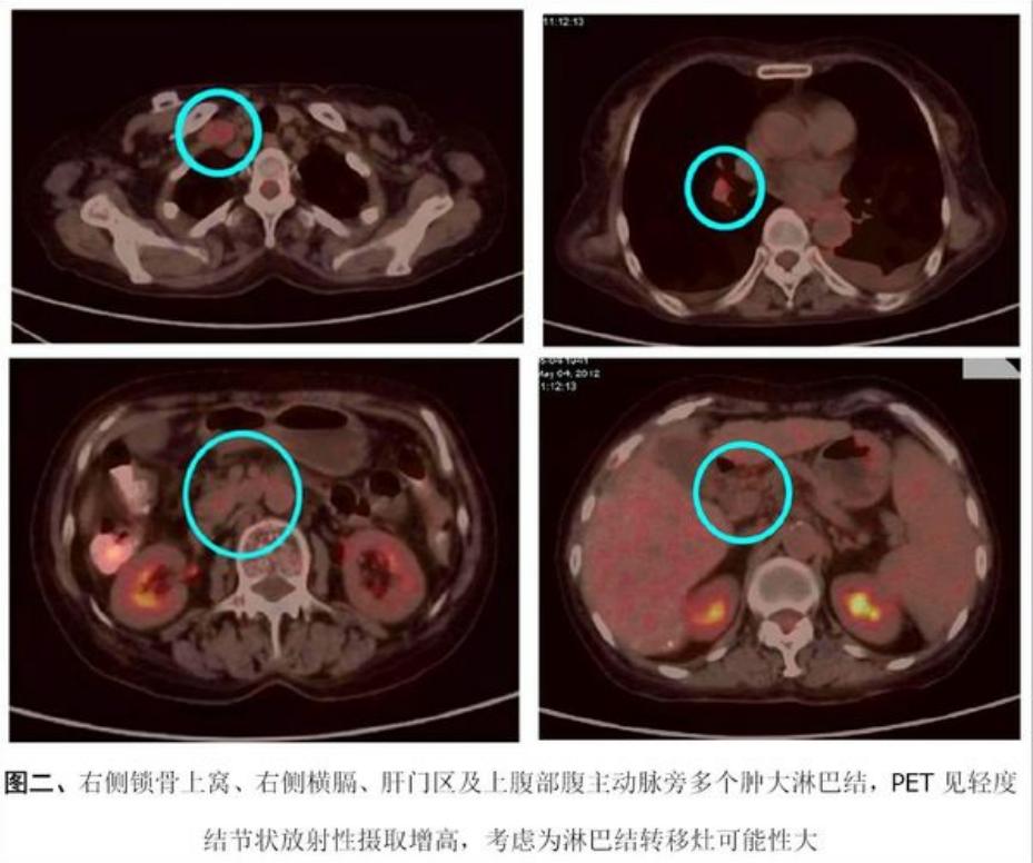 癌症转移无症状,癌症全身转移抗癌成功案例
