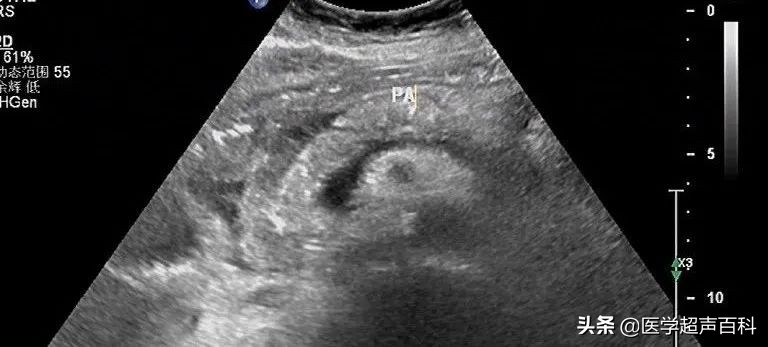 急性胰腺炎超声表现,犬急性胰腺炎超声