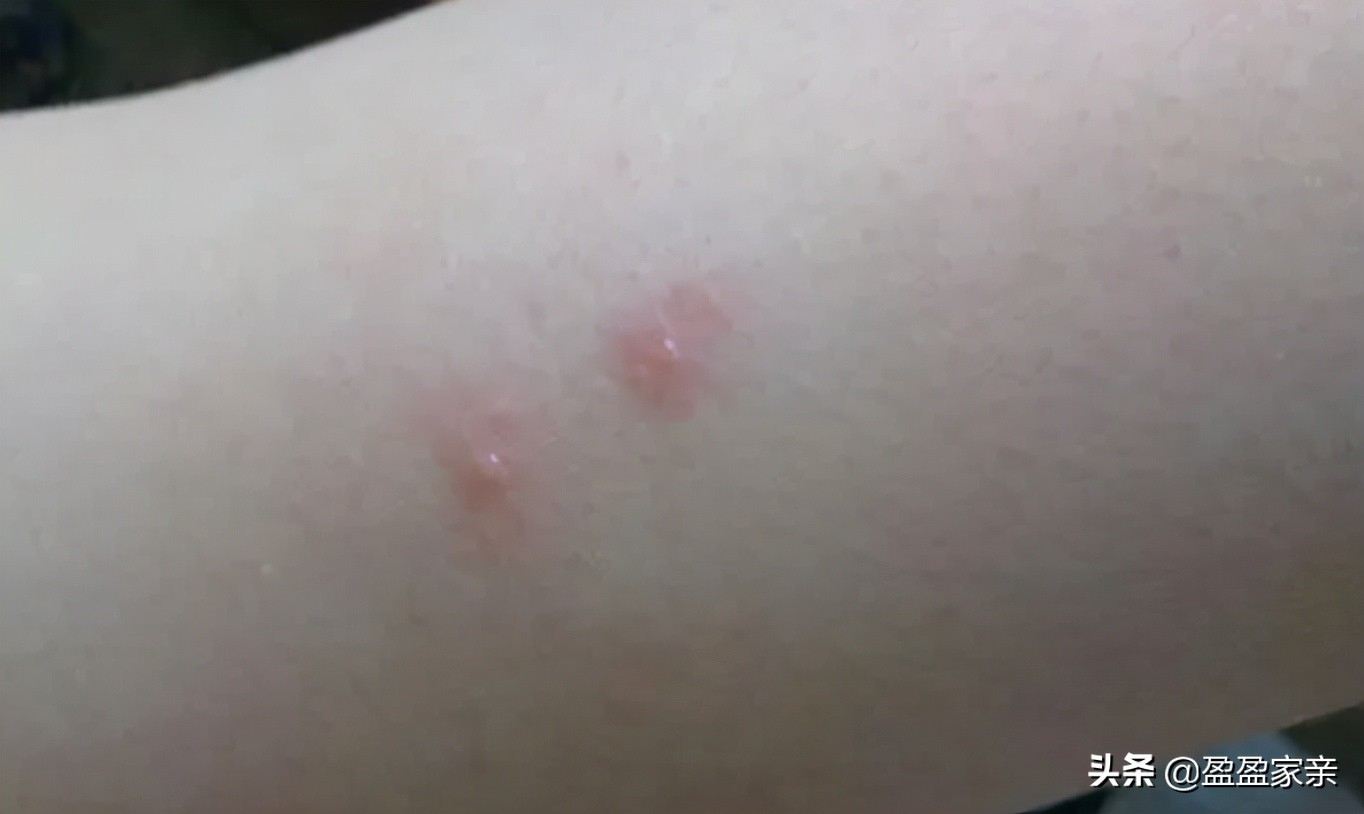 螨虫怎么消除最简单方法,生活中的螨虫怎么消灭