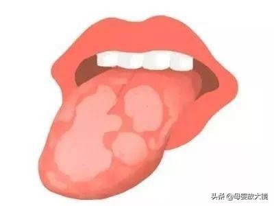 宝宝嘴巴鹅口疮反复舌苔颜色很深,初期鹅口疮上颚症状