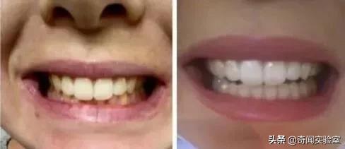 专治牙黄口臭的小窍门,牙黄口臭用什么牌子牙膏刷牙最好