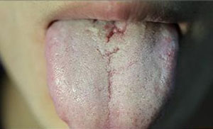 中医看舌头知病情图片,看舌头知病情图解大全