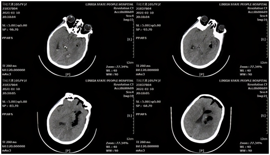 基层医院神经外科微创脑出血前景,高血压脑出血新突破