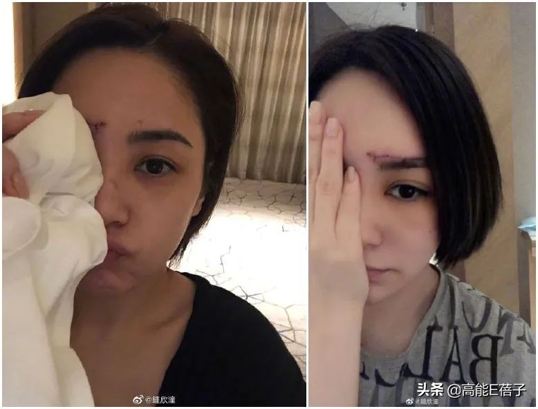 阿娇额头伤口恢复过程,阿娇晒伤口恢复照