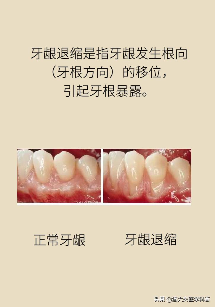 牙根暴露了该怎么刷牙,牙根治疗后可以刷牙吗