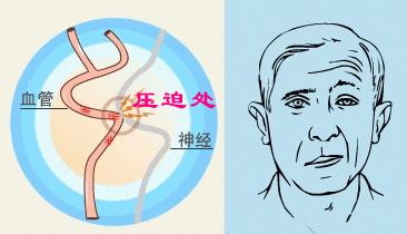 面肌痉挛右眼皮跳北京哪里治疗,眼皮一直抽搐跳动的原因面肌痉挛