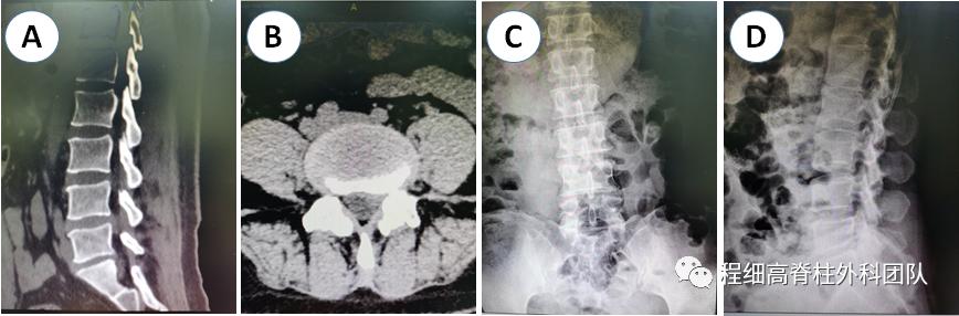 南大二附院程细高教授团队完成一例微创脊柱内镜椎板间入路L4/5脱垂髓核摘除术