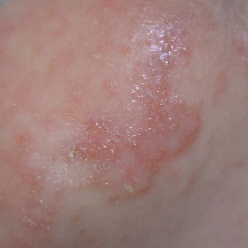 孩子老爱长痱子怎么办,儿童长痱子用什么药好