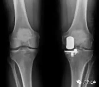 膝关节骨关节炎的阶梯型治疗方案,膝骨关节炎阶梯式治疗