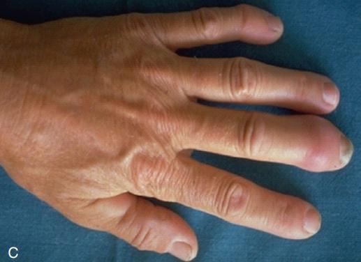 银屑病是什么样的病症,银屑病是免疫系统疾病