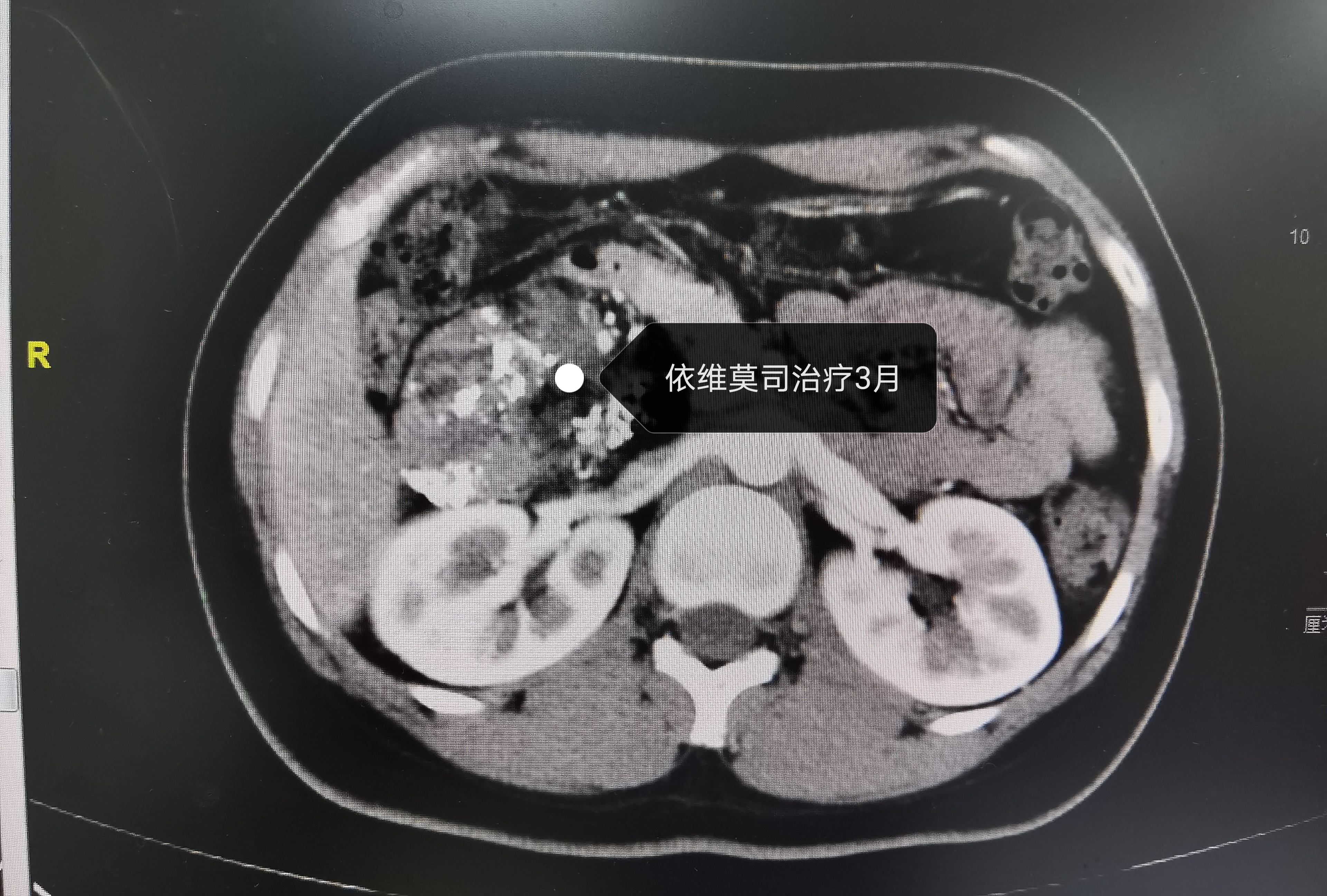 泌尿肿瘤mdt是什么意思,泌尿系肿瘤mdt专家共识