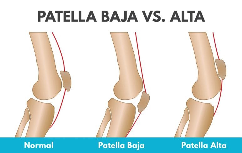 膝前疼痛如何治疗,髌骨软化症的症状与保守治疗方法