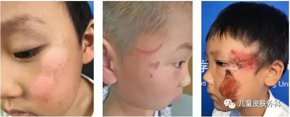 小孩被小孩抓伤需要检查什么,幼儿园孩子被幼儿抓伤急救方法