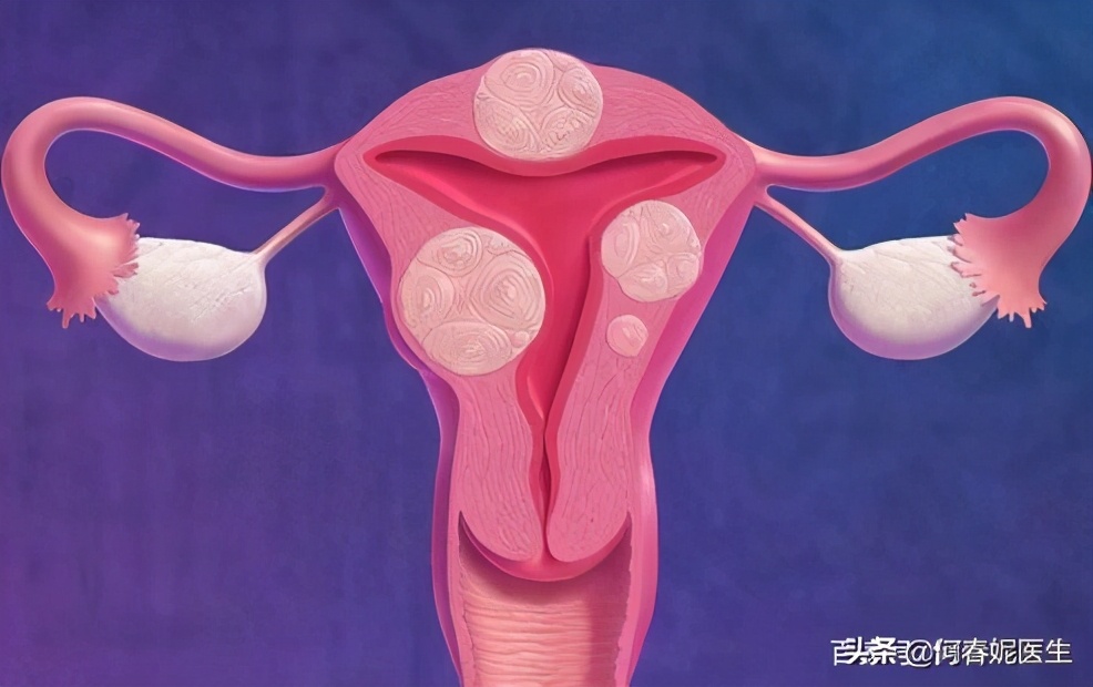 子宫肌瘤手术麻醉方式,子宫肌瘤手术需要住院几天