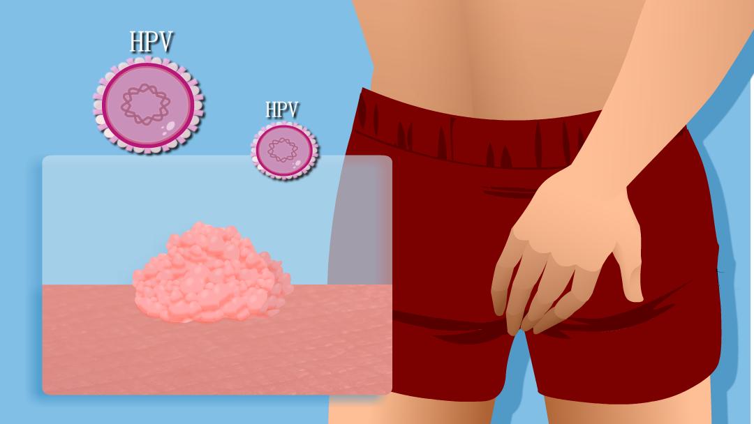 得了hpv一定会长尖锐湿疣吗,小伙口腔长尖锐病毒湿疣