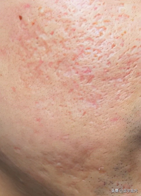 雀斑激光去除效果视频,雀斑激光祛除