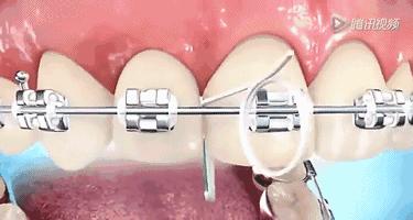 牙齿矫正戴了牙套怎么刷牙,戴上牙套之后还用牙膏刷牙