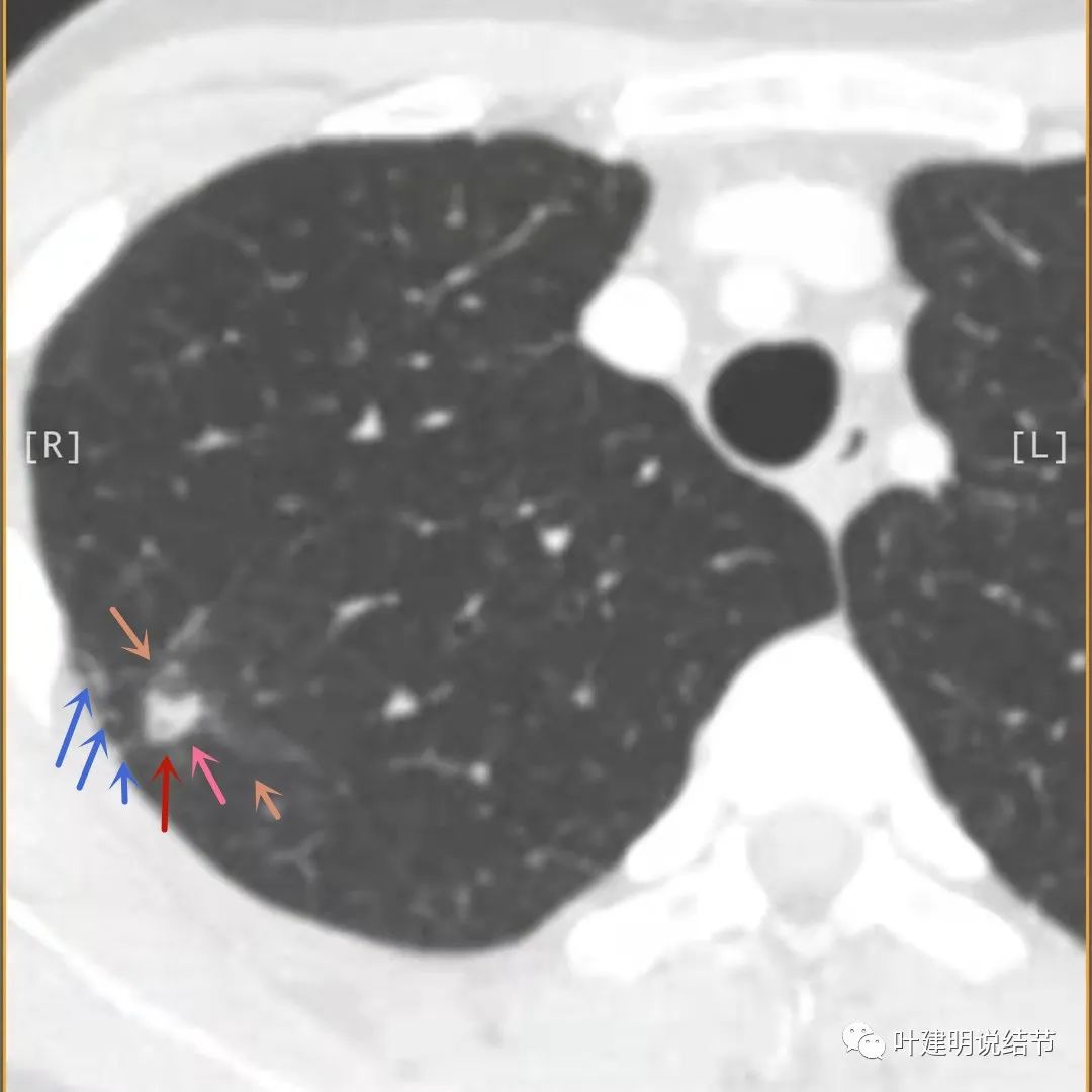 临床诊断孤立性肺结节,空洞型结节一般是什么性质