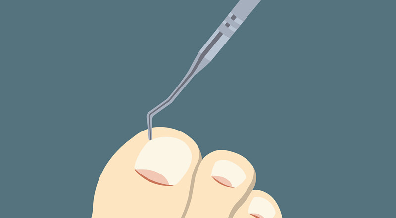 指甲长这样竟是癌症的信号,指甲透露的健康