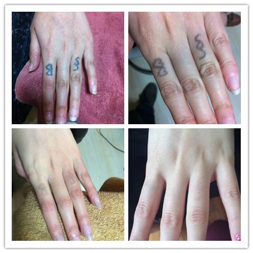 洗纹身咨询李医生,昆明李医生洗纹身是真的吗