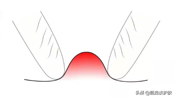 痘痘越挤越大越硬,痘痘黄了要不要挤
