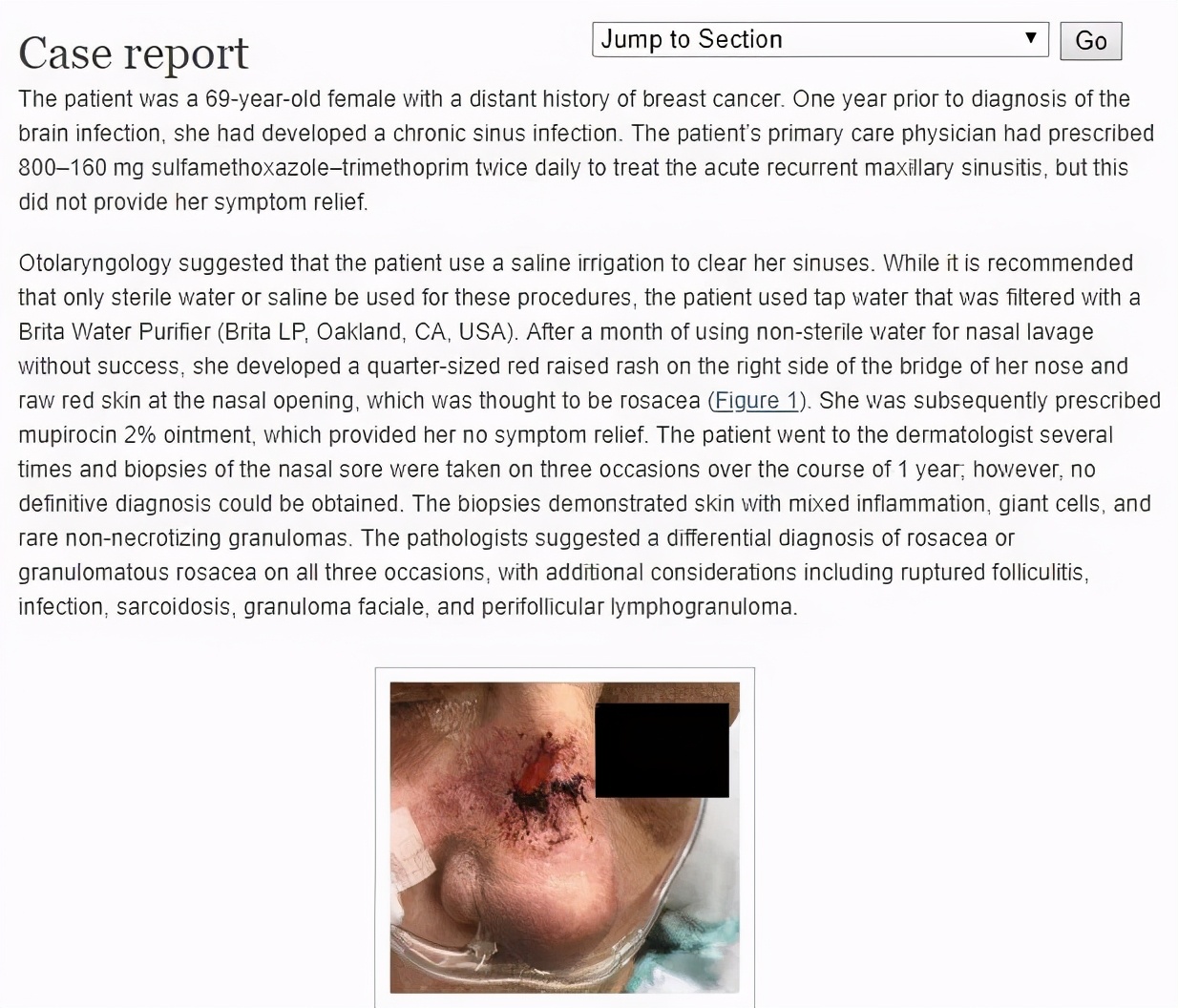 洗鼻生理盐水可以用自来水配吗,可以用自来水烧开兑洗鼻盐洗鼻吗