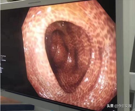 连吃两年芦荟胶囊排毒治便秘？52岁常德女子肠道竟吃成了“豹纹皮”