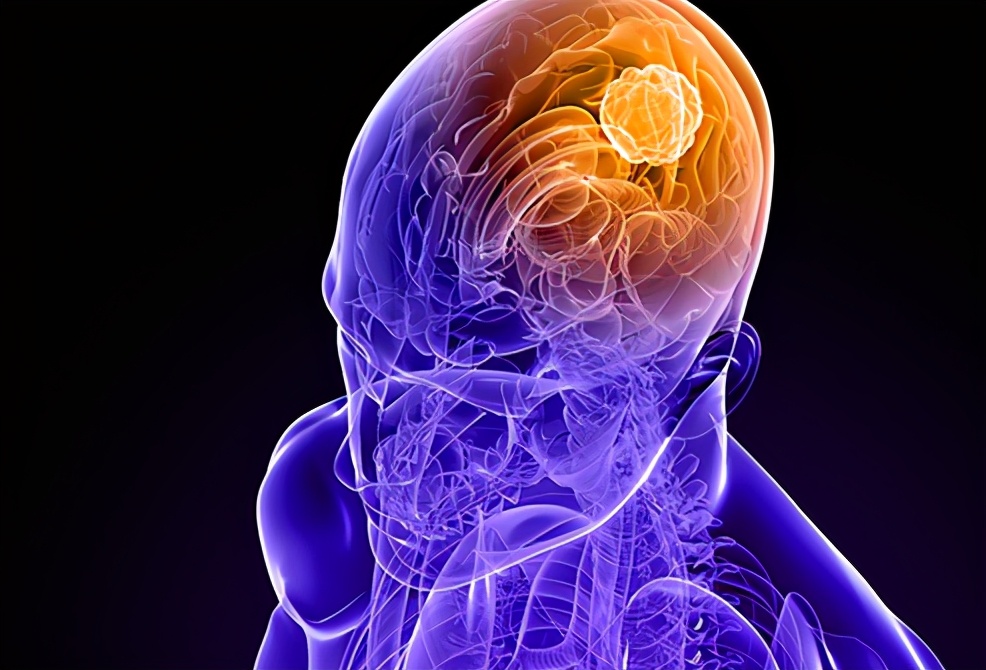大脑是人体司令部,出现脑癌常会引起头痛等异常,该如何正确应对