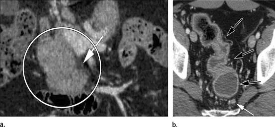 急性胰腺炎和慢性胰腺有什么症状,胰腺炎合并胰腺肿物