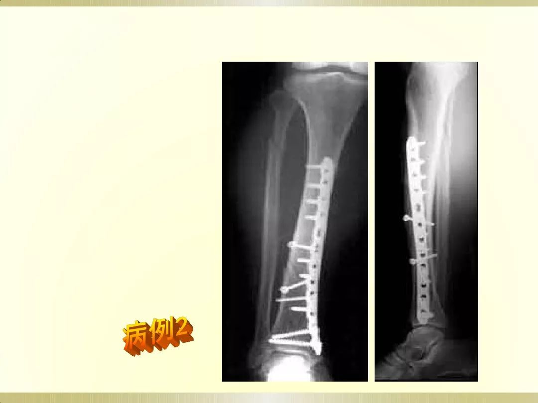 骨科x光片读片技巧,放射科骨科读片教程