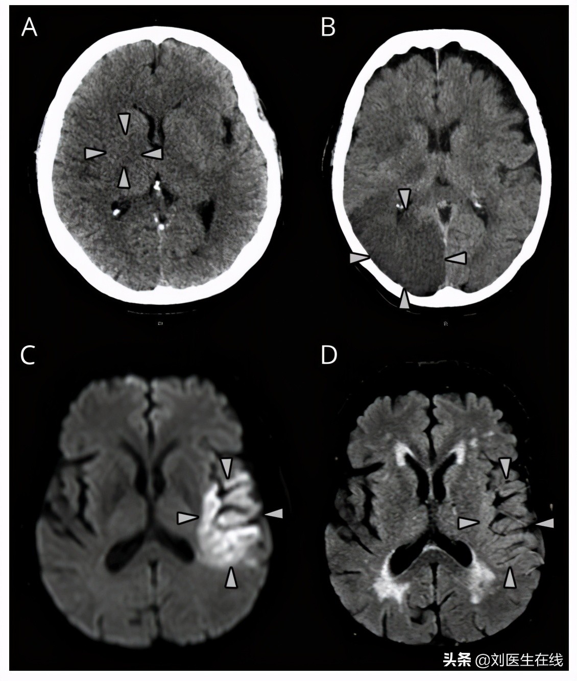 55岁王阿姨长期吃阿司匹林，却脑梗复发，医生心脏听诊找到了原因