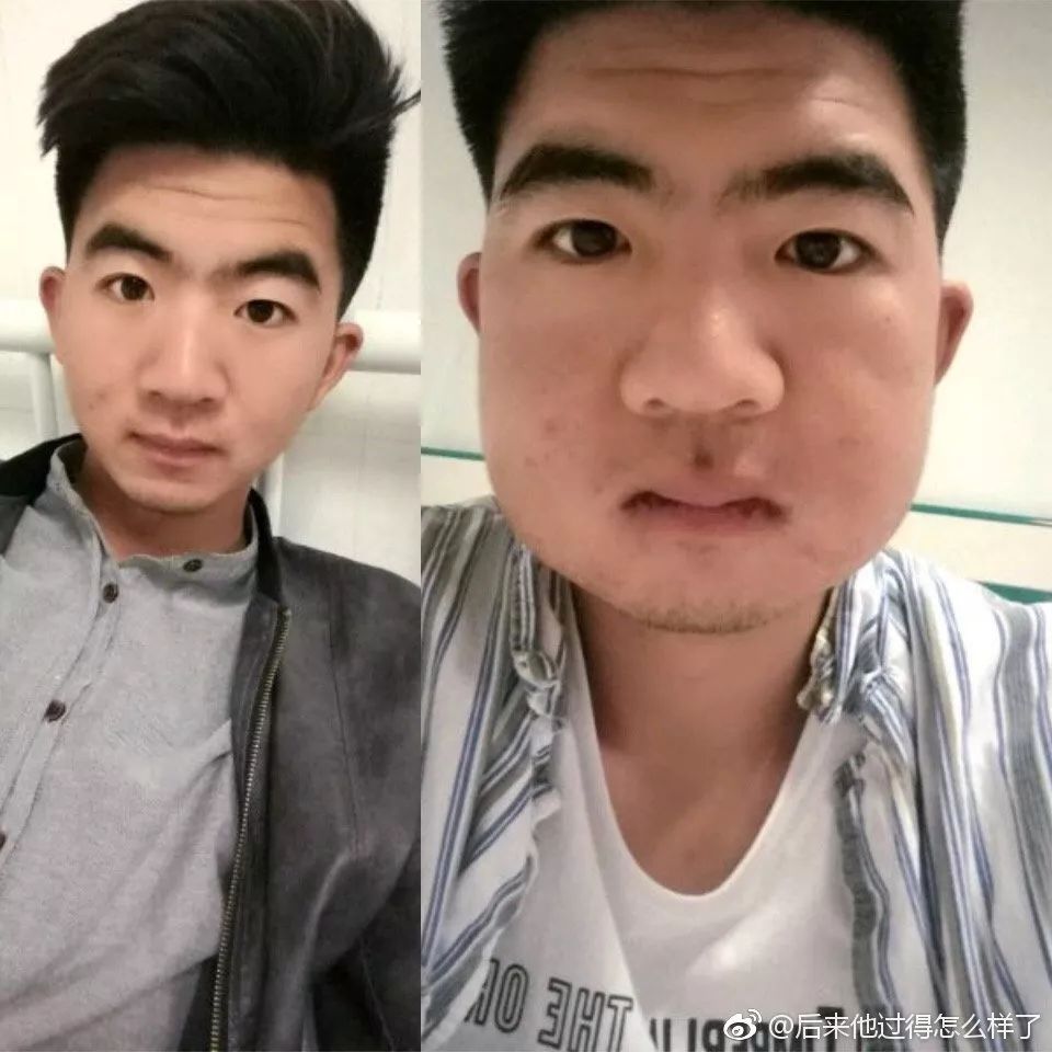 拔智齿是怎么算收费的,拔智齿是按智齿个数收费吗