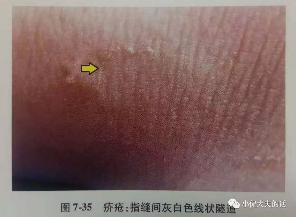 大猪猪蹄子脱落如何护理,大猪皮肤病治疗的最佳方法