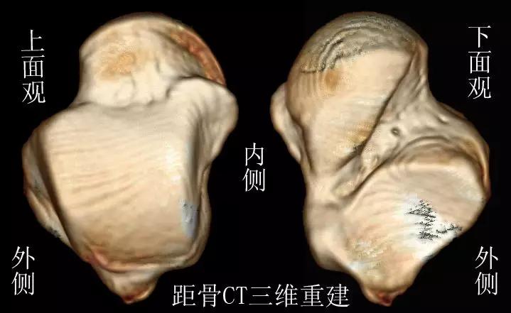 踝关节撞击症问诊,踝关节内侧撞击综合症位置图