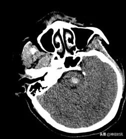 一例脑干出血的个案护理,外伤性脑干出血保守治疗成功案例