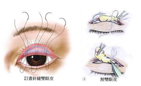 做完双眼皮为什么会有肉条感,做完双眼皮肉条感可以消除嘛