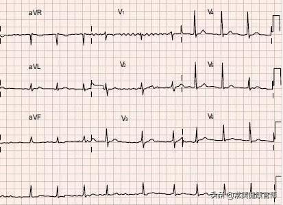 欧洲房颤指南,房颤最新指南解读