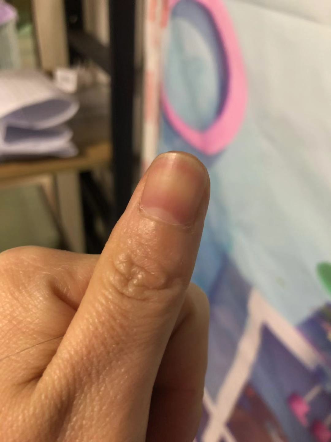 手指上只有大拇指有半月牙怎么办,手指的半月牙越来越少是什么原因