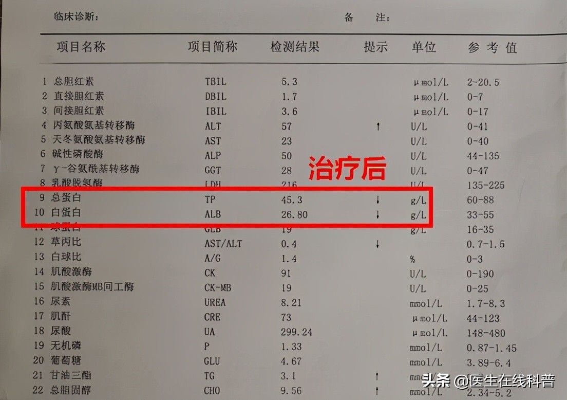 肾病综合征停药一个月又出现水肿,肾病综合征总复发心里恐慌怎么办