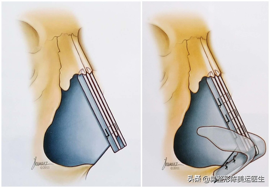 塌鼻子怎么能变成尖鼻子,鼻子太窄太小是不是很难增高鼻梁