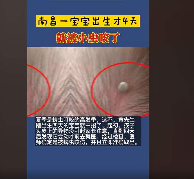 孩子被蜱虫幼虫咬了有事吗,小孩被蜱虫叮咬后怎么处理