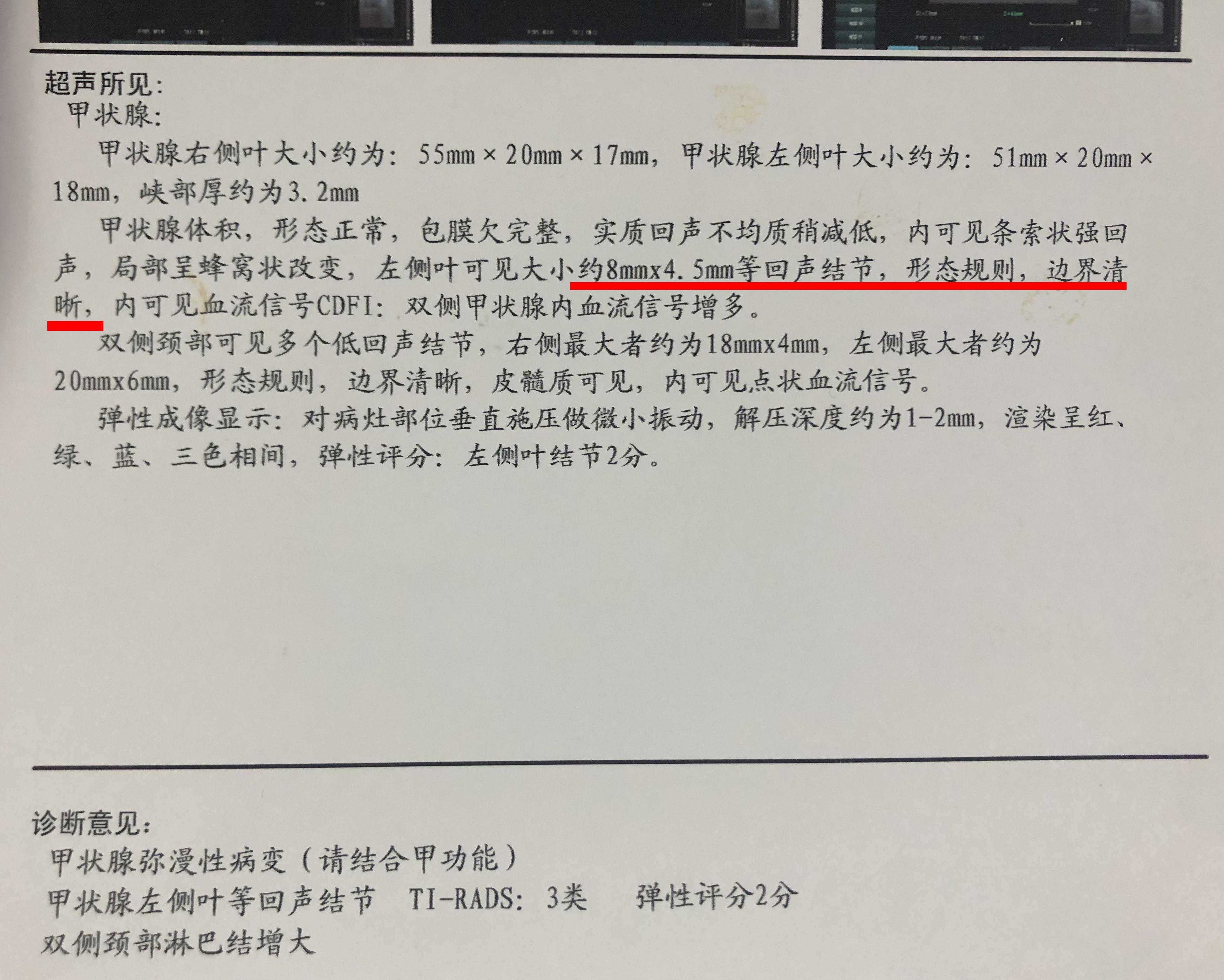 甲亢结节自愈的最佳方法,甲亢结节怎么消除最快最有效