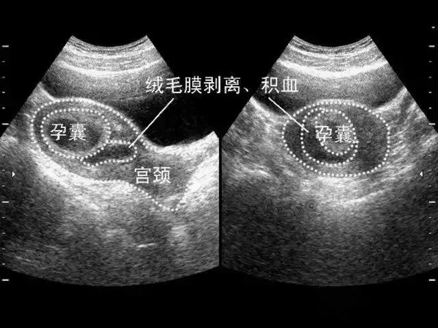 宫内早孕伴绒毛膜下血肿,绒毛膜下血肿和宫腔积血怎么鉴别