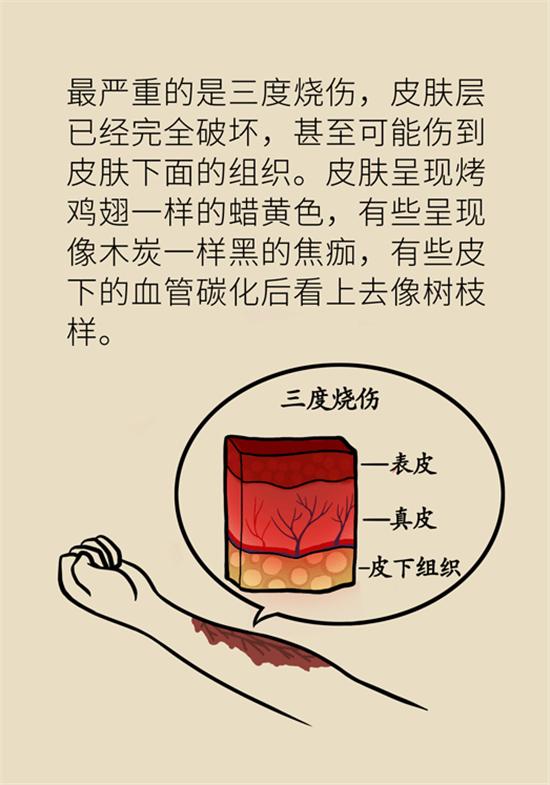 烫伤水泡如何换药,深2度烫伤换药总是有大水泡